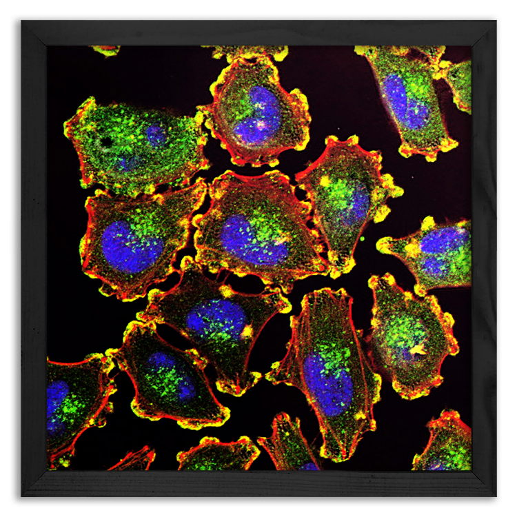 Mobility of melanoma cells