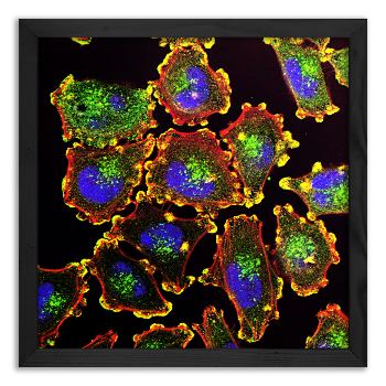 Mobility of melanoma cells